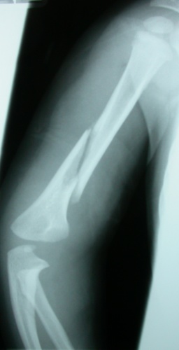 Humerus two