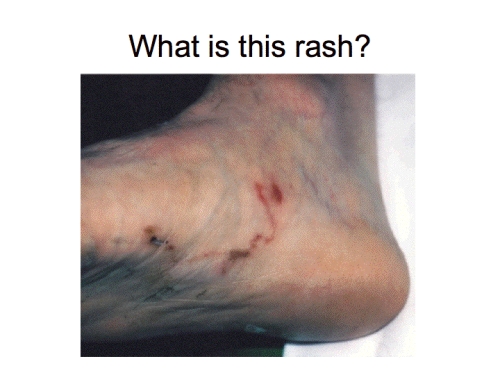 Rash on foot