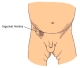 Inguinal hernia (male)