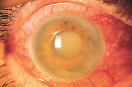 Appearance on slit lamp