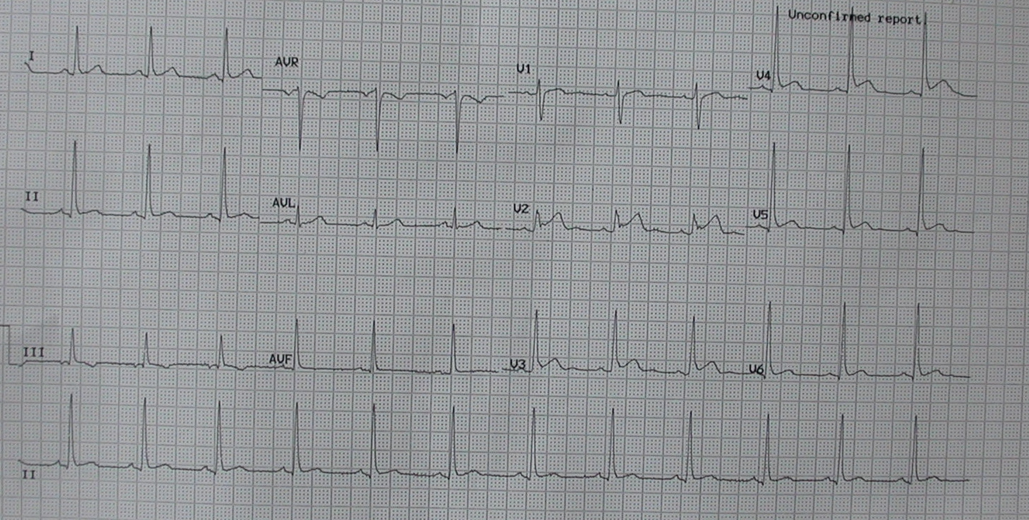 ECG 2