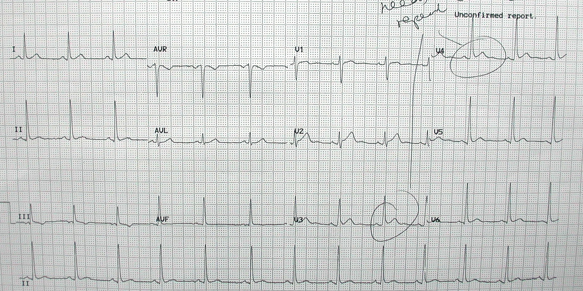 ECG 1