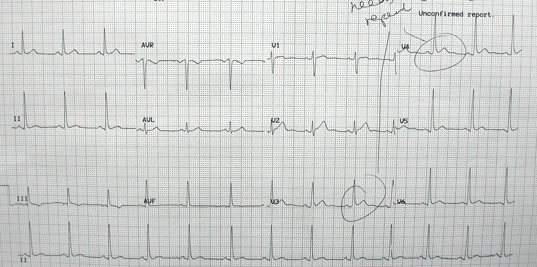 ECG 1