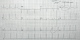 ECG 1