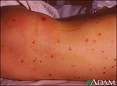 rash
