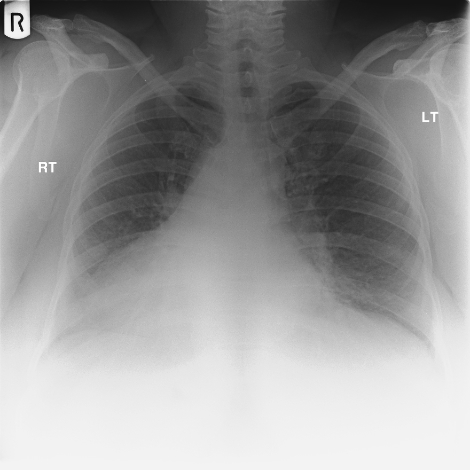 CXR