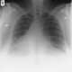 CXR