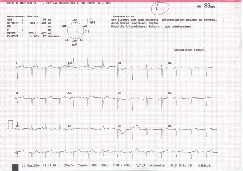 Initial ECG