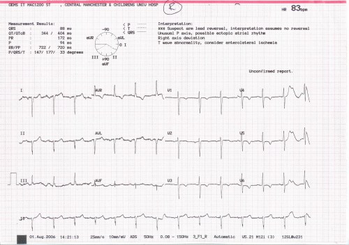 V leads over the right chest
