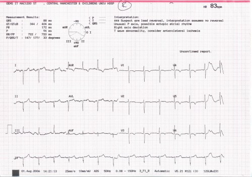 V leads over the right chest