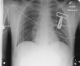 CXR