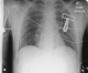 CXR