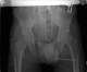 Pelvic XR