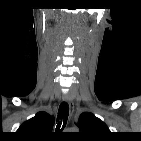 AP C Spine reconstruction 1