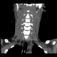AP C Spine reconstruction 2