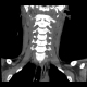 AP C Spine reconstruction 3
