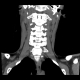 AP C Spine reconstruction 4