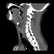 Lateral C Spine reconstruction
