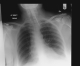 AP CXR