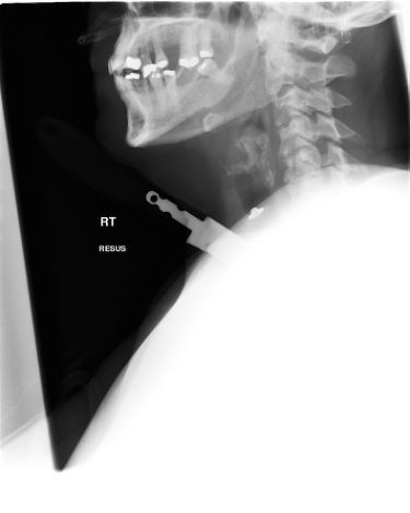 Lateral neck and upper thorax 2