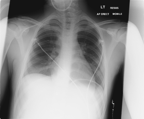 CXR