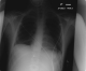 CXR 2