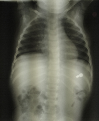 X-ray