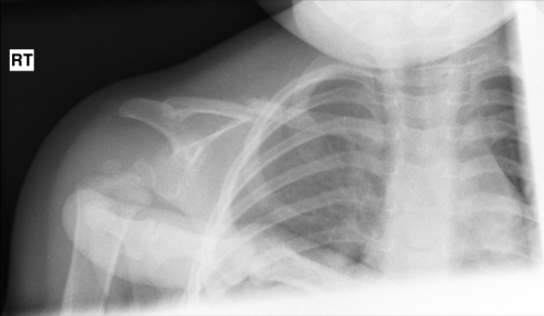 Right Clavicle