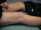 Mottled skin over knee
