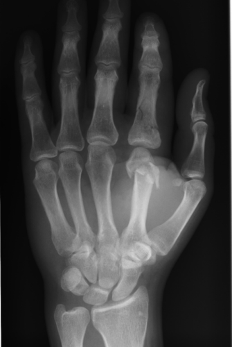X-ray AP Left Hand