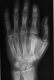 X-ray AP Left Hand