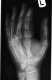 X-ray Oblique Left Hand