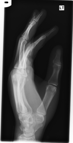 X-ray lateral left hand