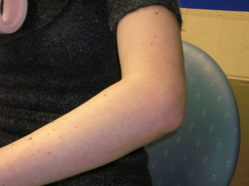 Swelling to Left Elbow