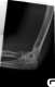 Lateral Left Elbow