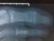 X-ray Right Great Toe