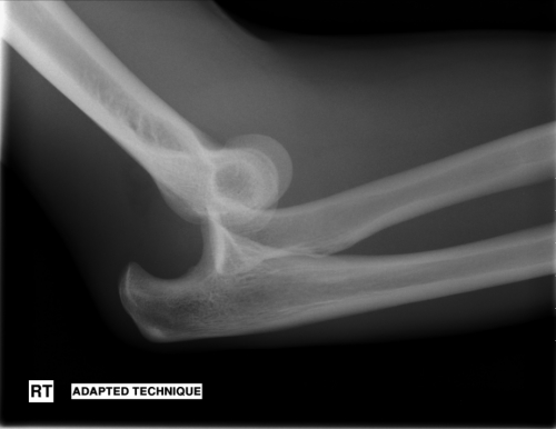 Lateral Right Elbow