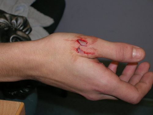 Laceration to Right Hand