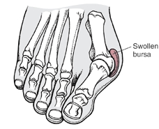 Hallux Valgus