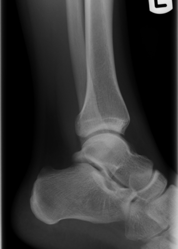 Lateral Left Ankle