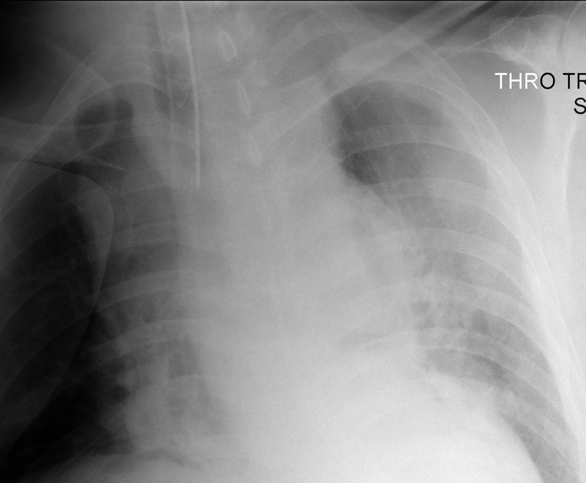 CXR 2