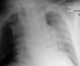 CXR 2