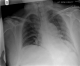 CXR