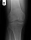 X-ray AP Right Knee