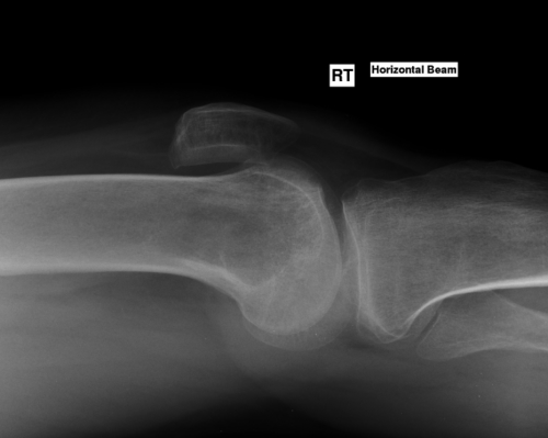 X-Ray Lateral Right Knee
