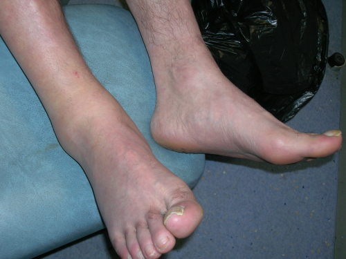 Comparison of right and left ankles